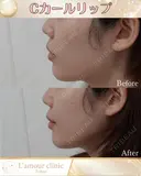 Cカールリップ before画像 サムネイル用