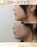Cカールリップ before画像 サムネイル用