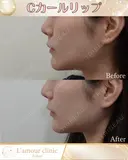 Cカールリップ before画像 サムネイル用