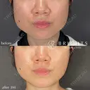 韓国製ボツリヌストキシン　エラ before画像 サムネイル用
