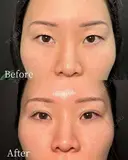二重埋没(自然癒着法) before画像 サムネイル用