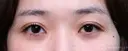 【20代女性・眠そうな目元】眼瞼下垂埋没法（直後・2ヶ月後） before画像 サムネイル用
