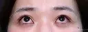 【20代女性・眠そうな目元】眼瞼下垂埋没法（直後・2ヶ月後） 0日後 サムネイル用
