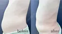 腹部脂肪吸引 after画像 サムネイル用
