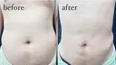 腹部脂肪吸引 after画像 サムネイル用