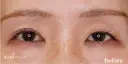 【30代女性・左右のバランスを整える】二重切開法（6ヶ月後） before画像 サムネイル用