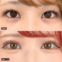 二重切開法（全切開・部分切開） before画像 サムネイル用