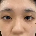 ドリームダブル・目頭切開 before画像 サムネイル用