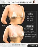ハイブリッド豊胸 30日後 サムネイル用