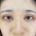 ドリームダブル・目頭切開 after画像 サムネイル用