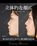 立体的な顔に before画像 サムネイル用