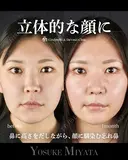 立体的な顔に 30日後 サムネイル用