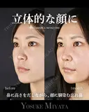 立体的な顔に 30日後 サムネイル用