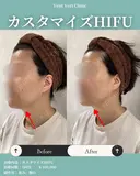 カスタマイズHIFU 0日後 サムネイル用
