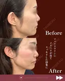 スレッド（糸）リフト after画像 サムネイル用