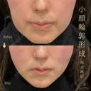 糸リフト・頬ヒアルロン酸・インモードForma両頬＋顎下 after画像 サムネイル用