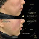 糸リフト・頬ヒアルロン酸・インモードForma両頬＋顎下 before画像 サムネイル用