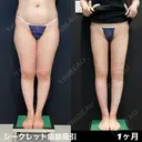 シークレット脂肪吸引脚フル 30日後 サムネイル用