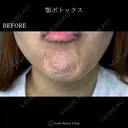 顎ボトックス🌷シワ取りボツリヌストキシン注射 before画像 サムネイル用