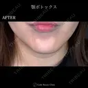 顎ボトックス🌷シワ取りボツリヌストキシン注射 7日後 サムネイル用