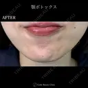 顎ボトックス🌷シワ取りボツリヌストキシン注射 7日後 サムネイル用