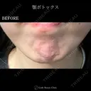 顎ボトックス🌷シワ取りボツリヌストキシン注射 before画像 サムネイル用