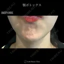 顎ボトックス🌷シワ取りボツリヌストキシン注射 before画像 サムネイル用