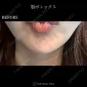 顎ボトックス🌷シワ取りボツリヌストキシン注射 before画像 サムネイル用