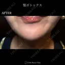 顎ボトックス🌷シワ取りボツリヌストキシン注射 7日後 サムネイル用