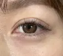 アリエルクイックループ（二重埋没法） 7日後 サムネイル用