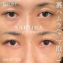 クマ取り(裏ハムラ法) before画像 サムネイル用