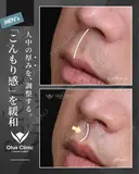 人中短縮(鼻柱切開) ・ 鼻翼縮小 ・ 鼻翼挙上 90日後 サムネイル用