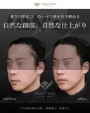 人中短縮(鼻柱切開) ・ 鼻翼縮小 ・ 鼻翼挙上 before画像 サムネイル用