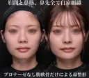 眉間と鼻筋、鼻先全て自家組織 before画像 サムネイル用