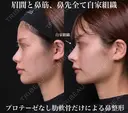 眉間と鼻筋、鼻先全て自家組織 180日後 サムネイル用