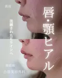 唇ヒアルロン酸　顎ヒアルロン酸 0日後 サムネイル用