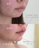 唇ヒアルロン酸、顎ヒアルロン酸 before画像 サムネイル用