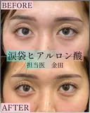 涙袋ヒアルロン酸 before画像 サムネイル用