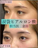 涙袋ヒアルロン酸 after画像 サムネイル用
