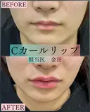 唇ヒアルロン酸（Cカールリップ） before画像 サムネイル用