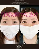 目尻切開・下眼瞼下制・目の下の切らないたるみ取り・コンデンスリッチ（目の下〜ゴルゴ） before画像 サムネイル用