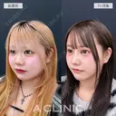1day小顔脂肪吸引で別人級の小顔に大変身！処置前と7ヶ月後の症例です before画像 サムネイル用