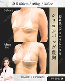 シリコンバッグ豊胸 30日後 サムネイル用