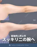 シンデレラ脂肪吸引(二の腕・肩) 150日後 サムネイル用