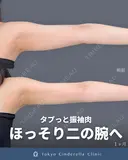 シンデレラ脂肪吸引(二の腕・肩) 30日後 サムネイル用