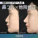 他院修正鼻フルコース［クローズ法］（鼻複合自家組織移植術）＋筋膜移植 before画像 サムネイル用