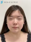 SEAライン ‐３D脂肪吸引（頬・顎）/ジョールファット　オプション‐・糸リフト- before画像 サムネイル用