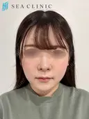 SEAライン ‐３D脂肪吸引（頬・顎）/ジョールファット　オプション‐・糸リフト- 60日後 サムネイル用