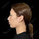 💠🩵『あご先リフト』🩵💠　〜横顔美人を叶える✨〜 after画像 サムネイル用