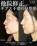 【🏆鼻尖形成🏆】 before画像 サムネイル用